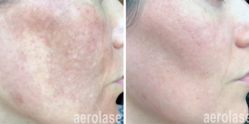 The Science Behind Aerolase: Why We Love This Laser