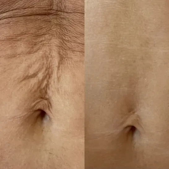 Aerolase® Laser before and after result 1
