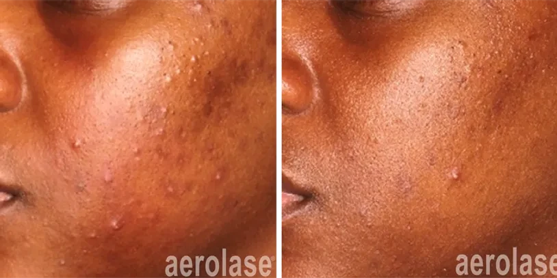 Aerolase® Laser before and after result 3