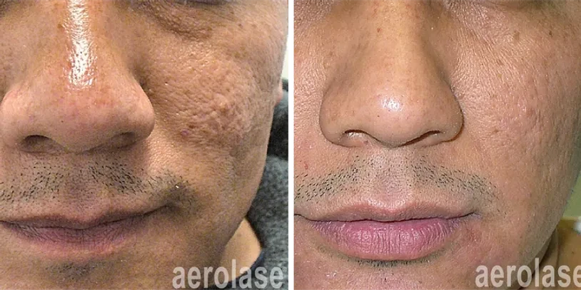 Aerolase® Laser before and after result 4