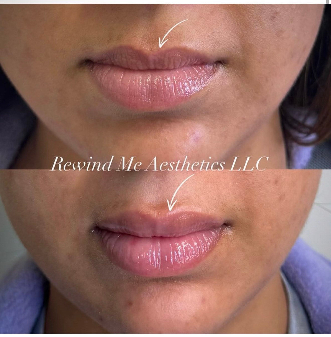 Dermal Fillers before and after result 1