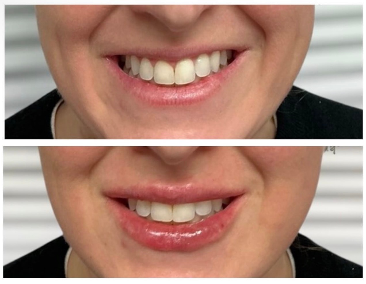 Dermal Fillers before and after result 2
