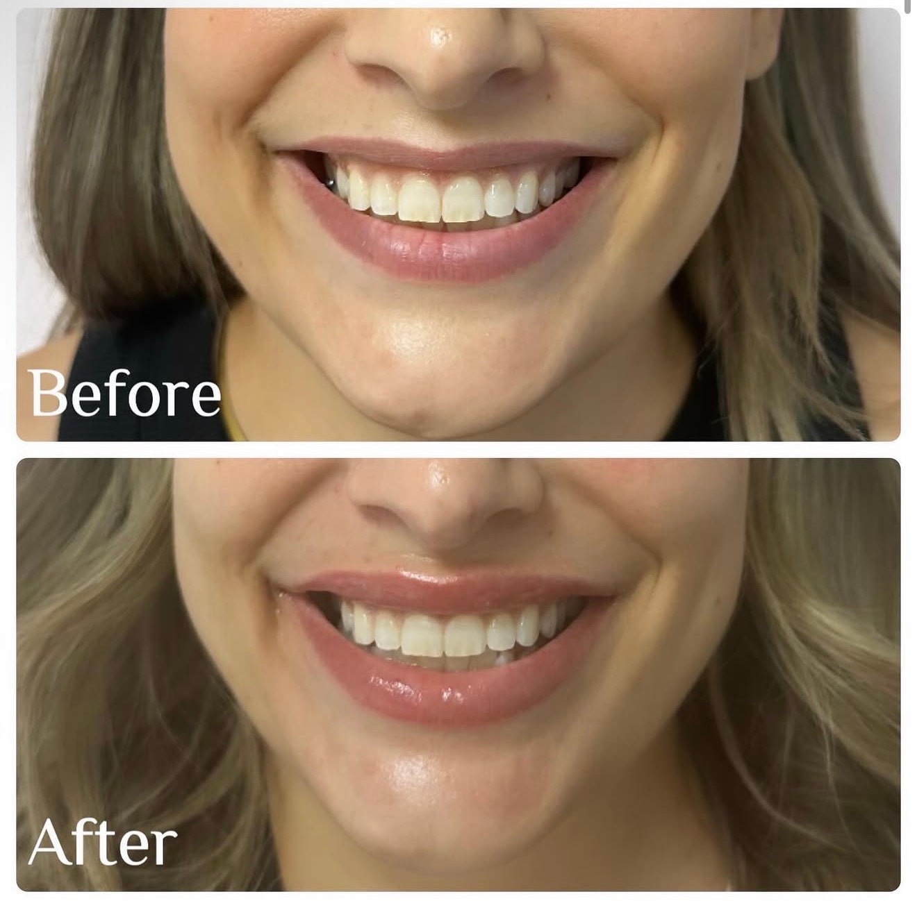 Dermal Fillers before and after result 3