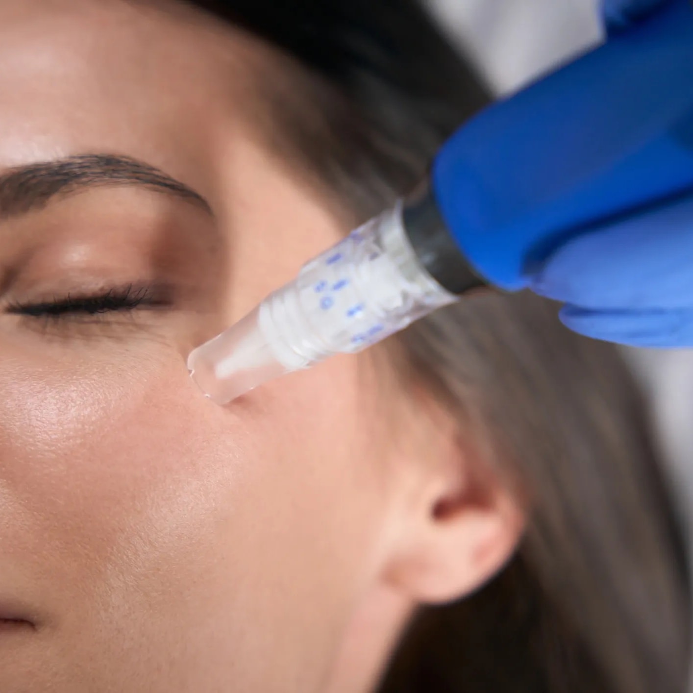 Microneedling with Hyaluronic Acid