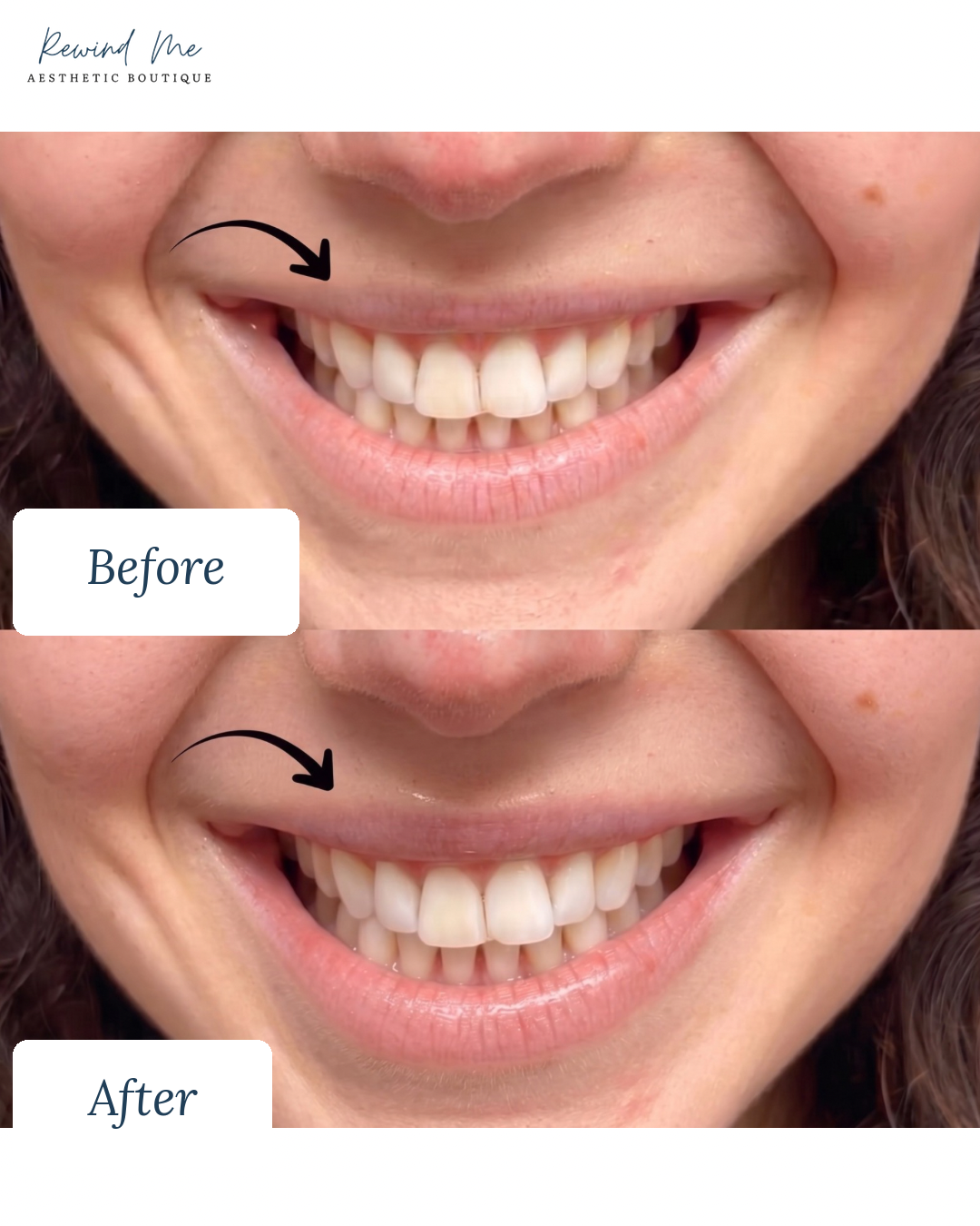 Neurotoxins before and after result 1