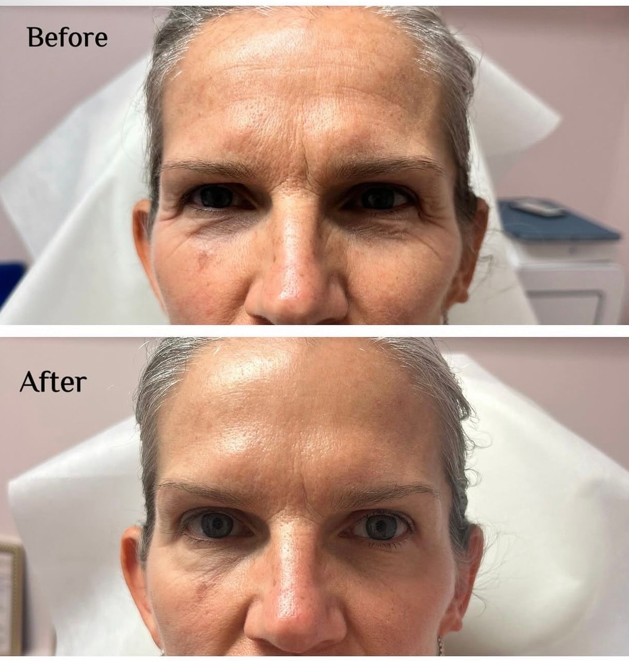 Neurotoxins before and after result 2